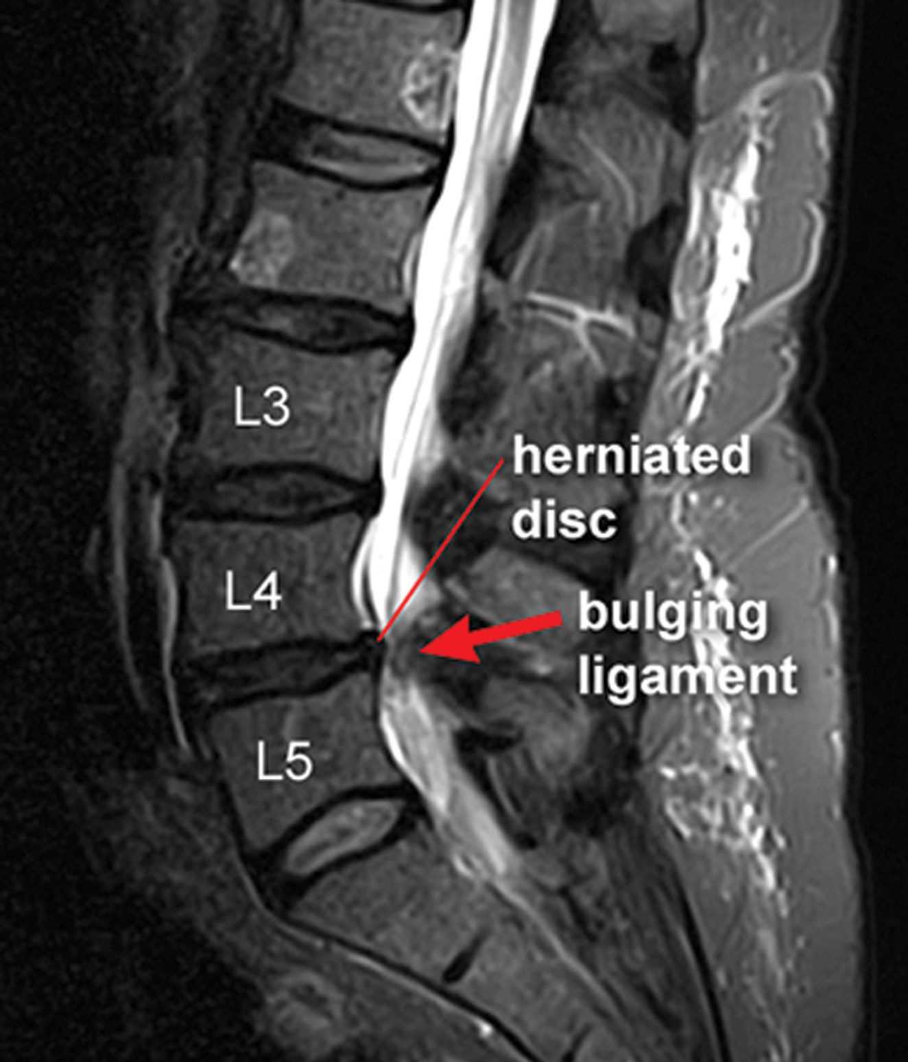 Painful Disc Herniations Alternative Treatment Options to Get you Back