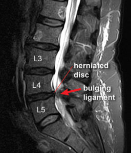 Painful Disc  Herniations