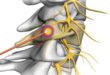 Radiofrequency Ablation For Pain Management