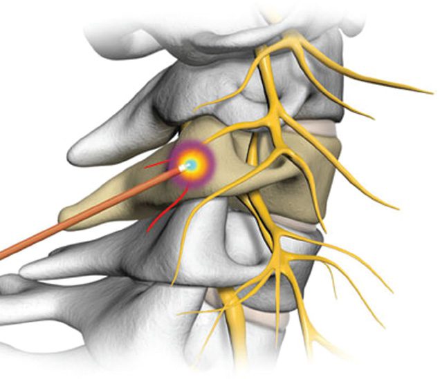 Radiofrequency Ablation For Pain Management - Central Florida Health ...