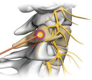 Radiofrequency Ablation For Pain Management