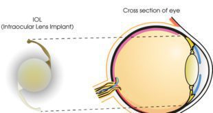 The IOL acts as a total replacement for your natural lens. Once implanted, with the aid of advanced technology, the IOL is customized to your eye to reduce or eliminate your need for glasses. The lOL will function and feel just like a healthy, cataract-free lens. After a short healing period, the IOL requires no special maintenance.