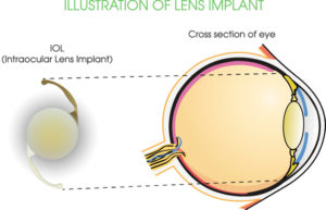 The IOL acts as a total replacement for your natural lens. Once implanted, with the aid of advanced technology, the IOL is customized to your eye to reduce or eliminate your need for glasses. The lOL will function and feel just like a healthy, cataract-free lens. After a short healing period, the IOL requires no special maintenance.