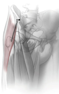 HIP REPLACEMENT SURGERY