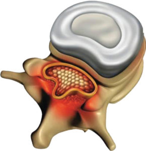 Spinal Stenosis