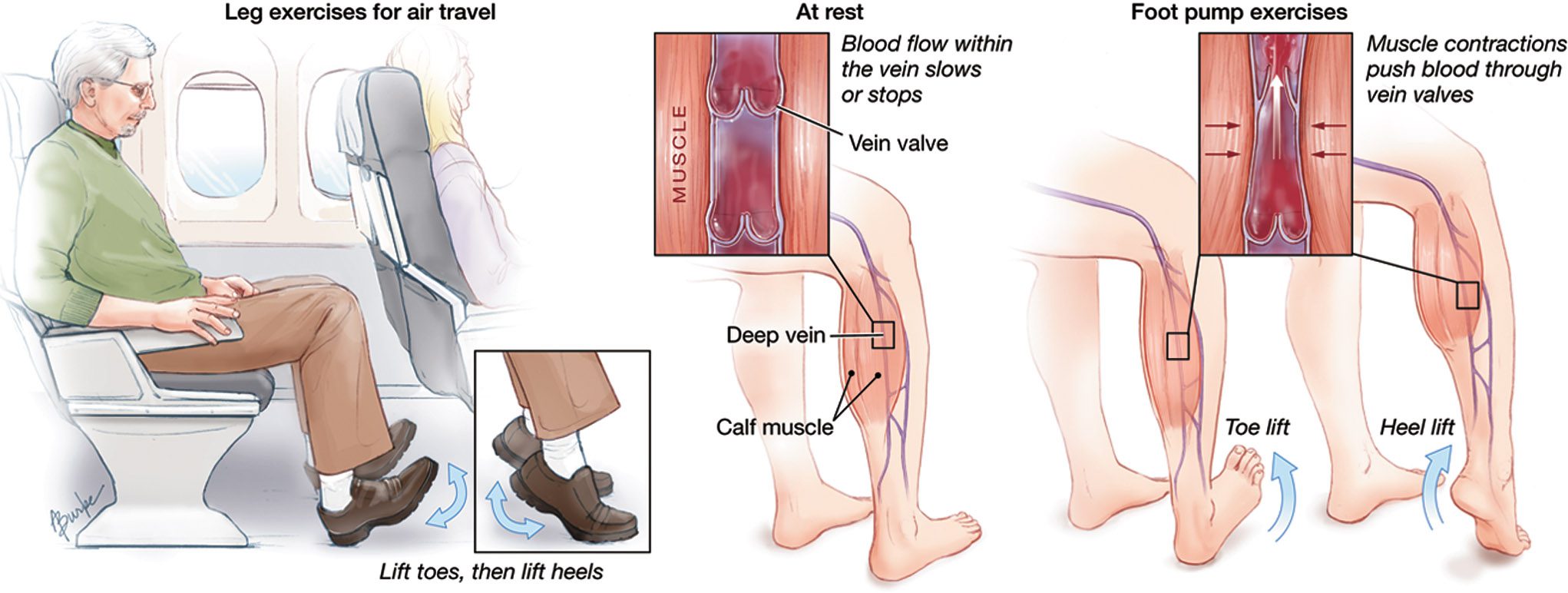 Traveling Tips for Venous Insufficiency