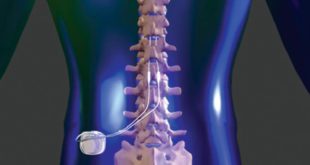 Is Spinal Cord Stimulation the Answer to Your Pain?