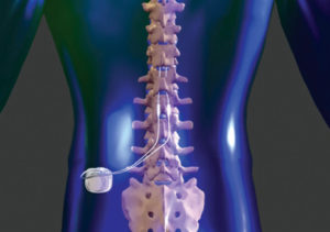 Is Spinal Cord Stimulation the Answer to Your Pain?