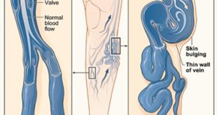 Leg Swelling Causes