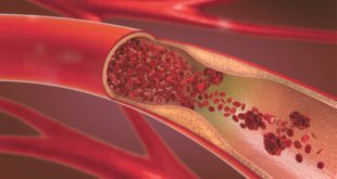 Peripheral Vascular Disease A Stealthy Disease Not to Be Ignored