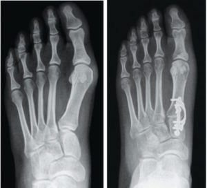 Bunion Corrections 