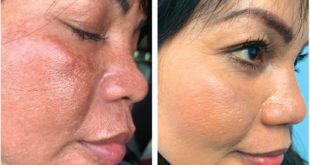 WE ARE NOW OFFERING STEM CELL FACIAL RESURFACING TREATMENTS