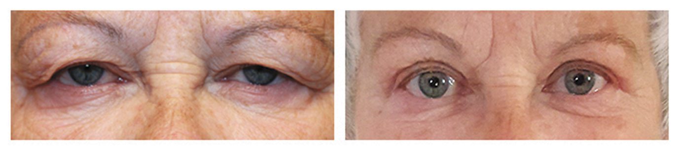 Eyelid Surgery