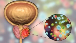 Prostate Cancer and COVID-19