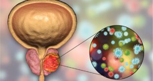 Prostate Cancer and COVID-19