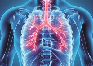 Chronic Obstructive Pulmonary Disease