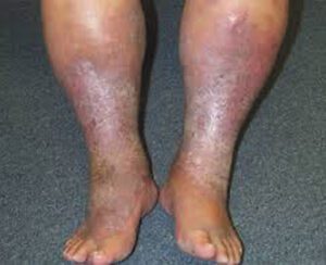 Venous Insufficiency