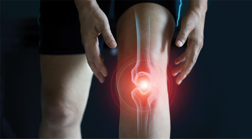 Knee Arthritis 1024x566 