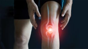 Knee Arthritis