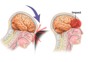 Traumatic Brain Injury