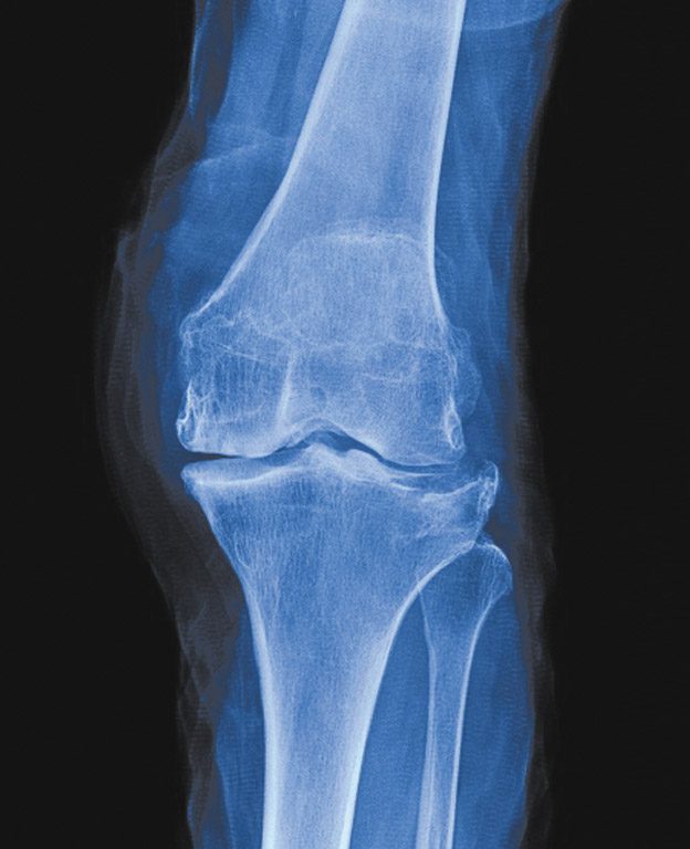 the-most-common-causes-of-cartilage-loss-central-florida-health-and