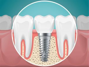 Dental Implants