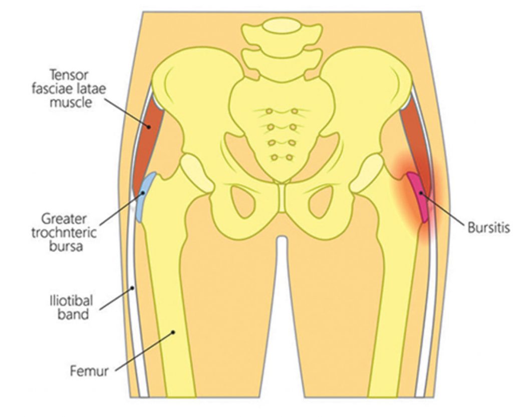 IT’S NOT HIP BURSITIS 3 REASONS WHY YOUR HIP HURTS Central Florida