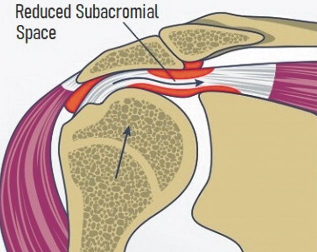 6 REASONS WHY YOUR SHOULDER IS CLICKING Central Florida Health and