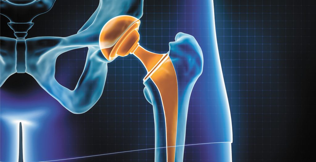 Do You Need Hip Replacement Surgery? What Are Your Options? Central