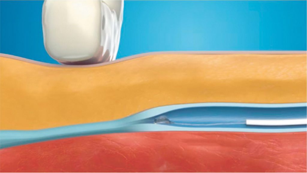 Venaseal Cyanoacrylate Adhesive Now Available to Treat Varicose Veins
