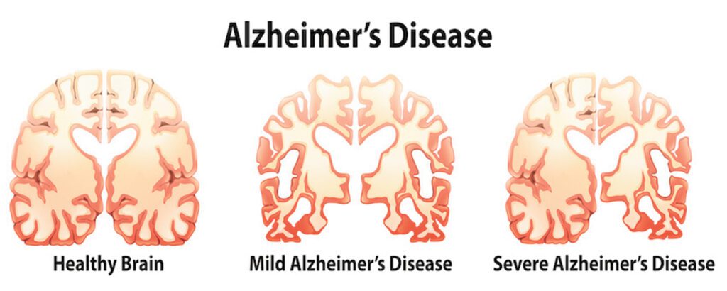 Alzheimer’s and Dementia