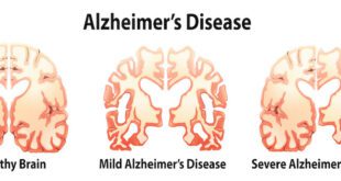 Alzheimer’s and Dementia