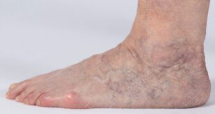 Treating Ankle Flare