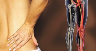 Sciatica and Neuropathy