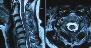 Understanding Your MRI Report