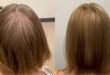 Before and After 2 TED Treatments by Dr. Alan Bauman