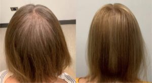 Before and After 2 TED Treatments by Dr. Alan Bauman