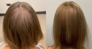 Before and After 2 TED Treatments by Dr. Alan Bauman