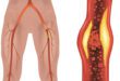 Peripheral Arterial Disease