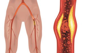 Peripheral Arterial Disease
