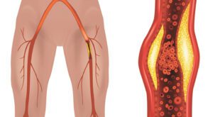 Peripheral Arterial Disease
