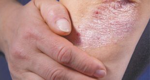 Psoriasis