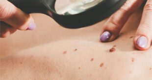 Squamous Cell Carcinoma