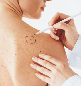 Basal Cell Carcinoma