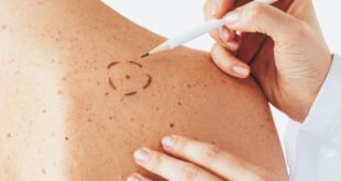 Basal Cell Carcinoma