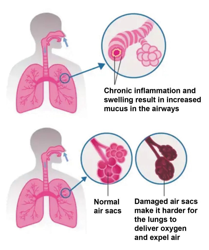 COPD in Seniors