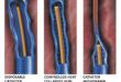 Varicose Vein Treatment