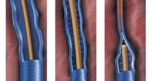Varicose Vein Treatment
