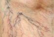 Understanding Spider Veins