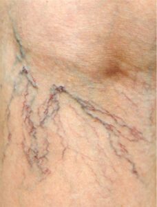 Understanding Spider Veins